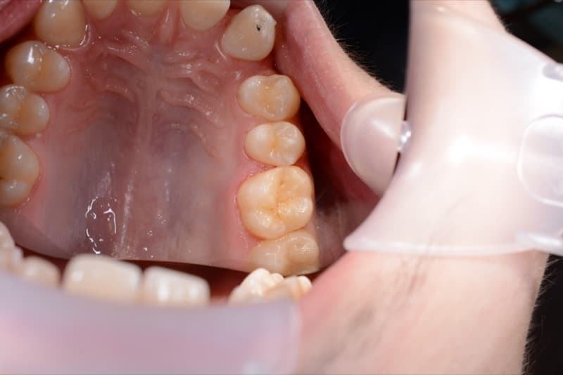 После: лечение кариеса