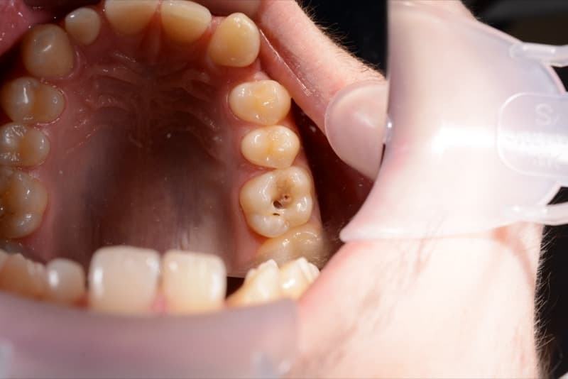 До: лечение кариеса