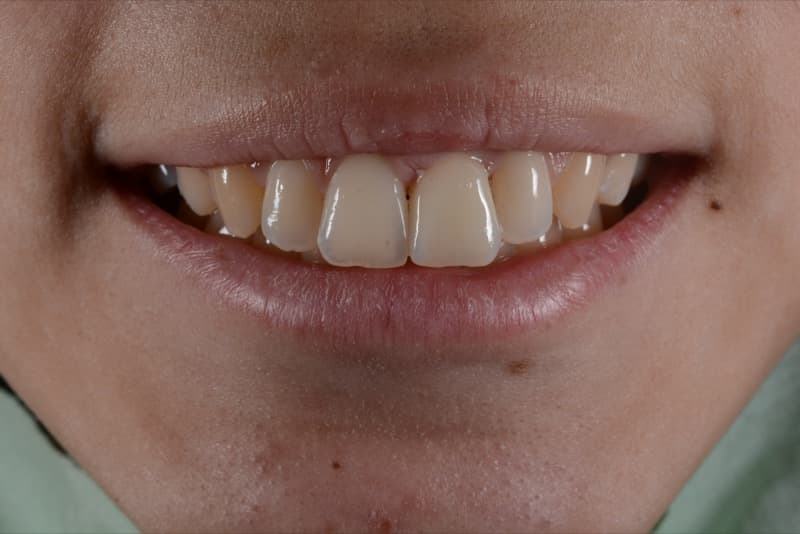 После: установка коронки