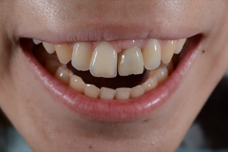 До: установка коронки