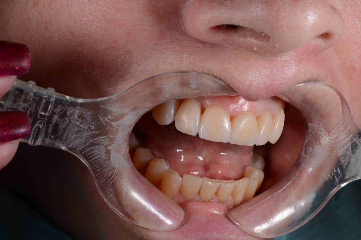 После: реставрация фронтальной группы зубов