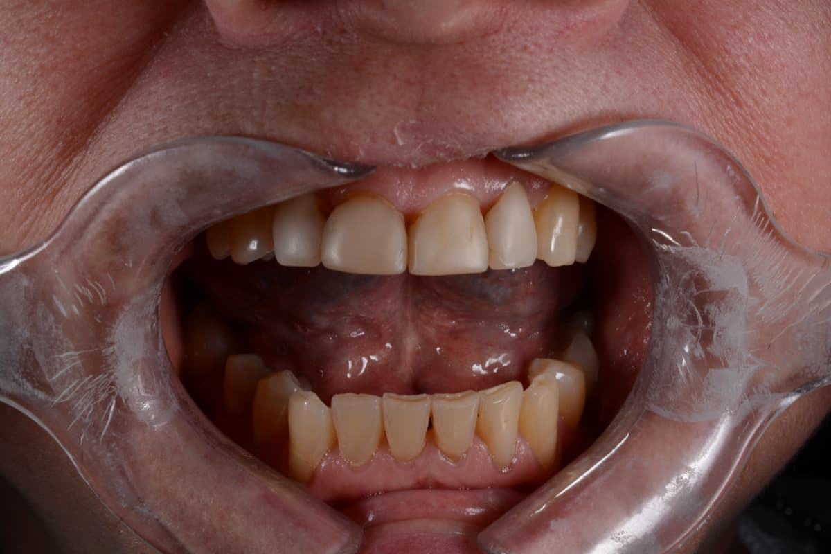 До: реставрация фронтальной группы зубов