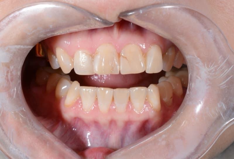 До: реставрация резцов