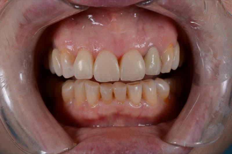 После: реставрация зубов 11, 12, 21