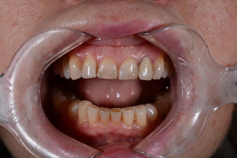 До: реставрация зубов 11, 12, 21