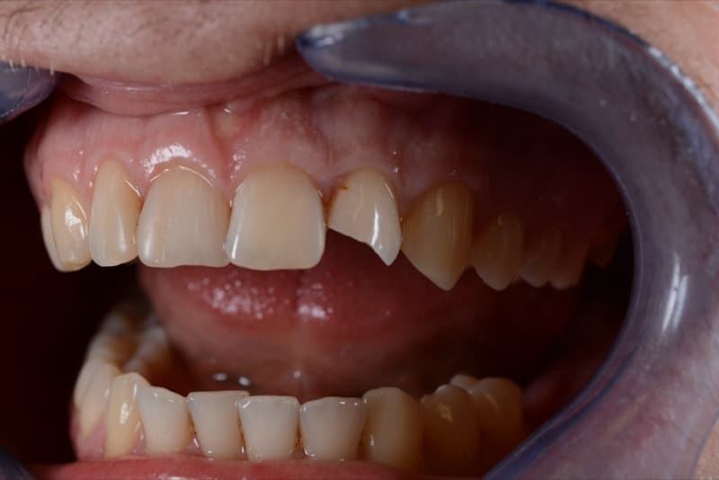 До: восстановление зуба 22