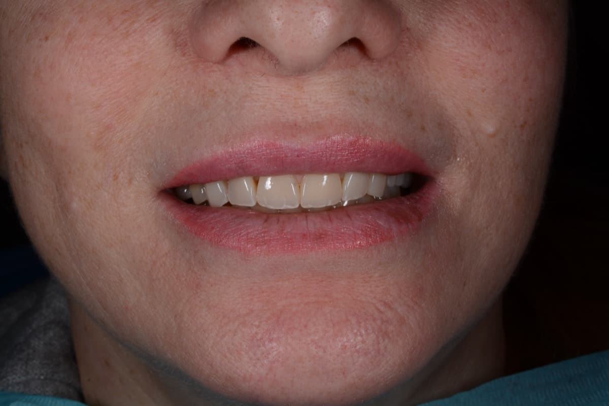 После: реставрация зубов