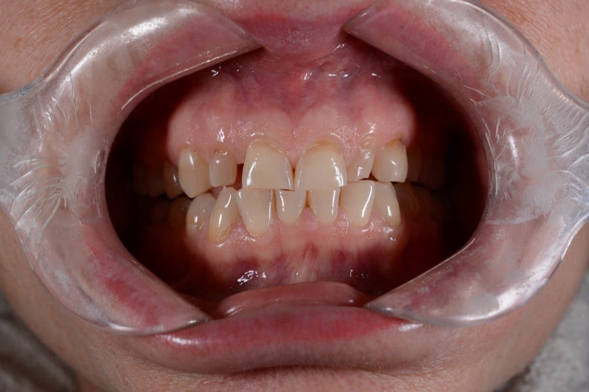 До: реставрация зубов