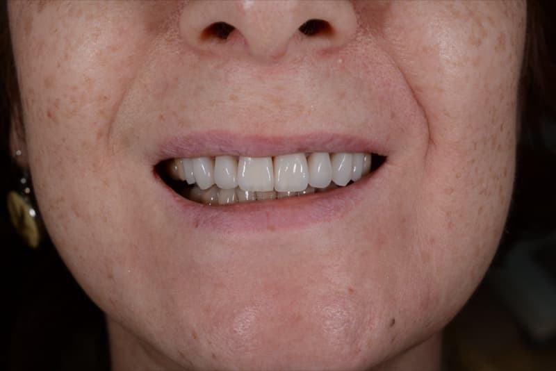 После: реставрация верхней челюсти