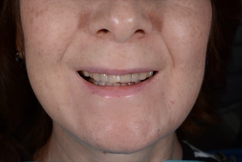 До: реставрация верхней челюсти